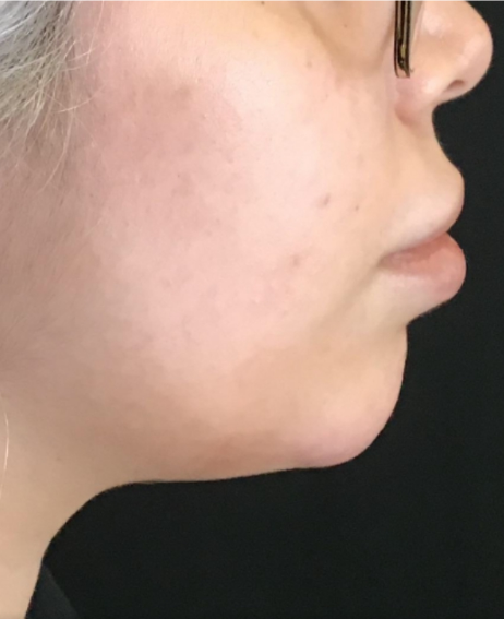 Dermal Fillers Case 48 After Image