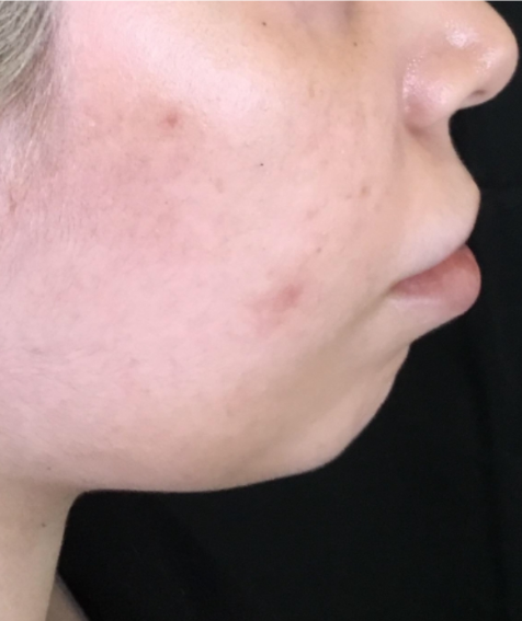 Dermal Fillers Case 48 Before Image