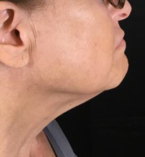 Coolsculpting® ELITE Case 46 After Image