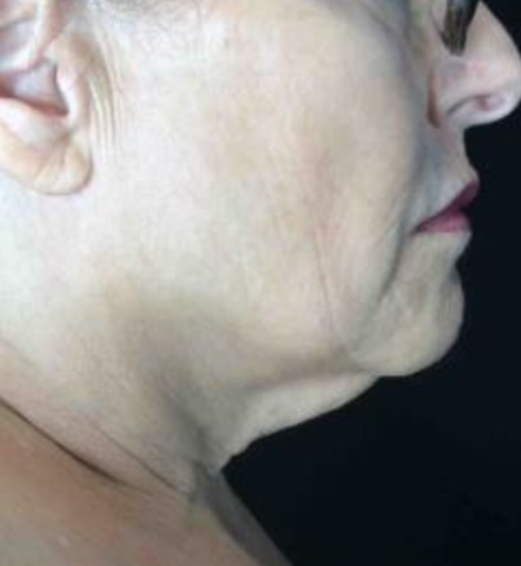 Coolsculpting® ELITE Case 46 Before Image