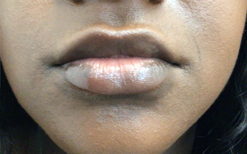 Lip Injections Case 41 After Image