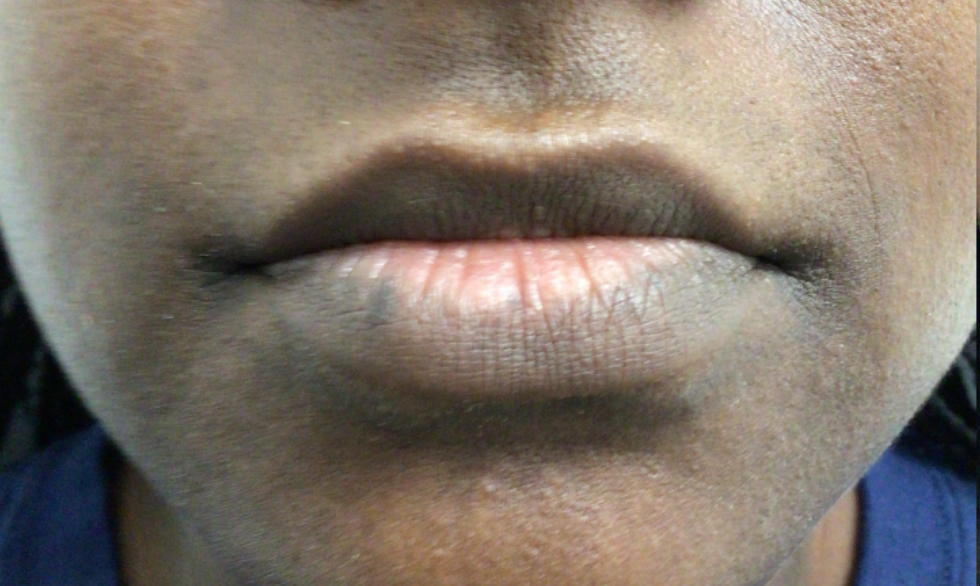 Lip Injections Case 41 Before Image