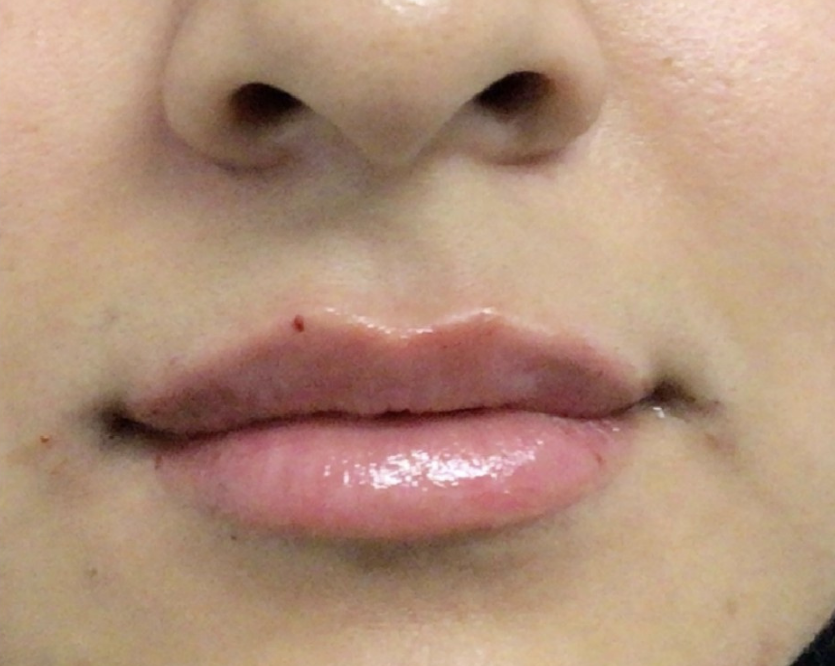 Lip Injections Case 42 After Image