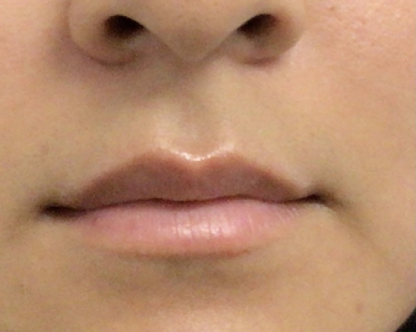 Lip Injections Case 42 Before Image