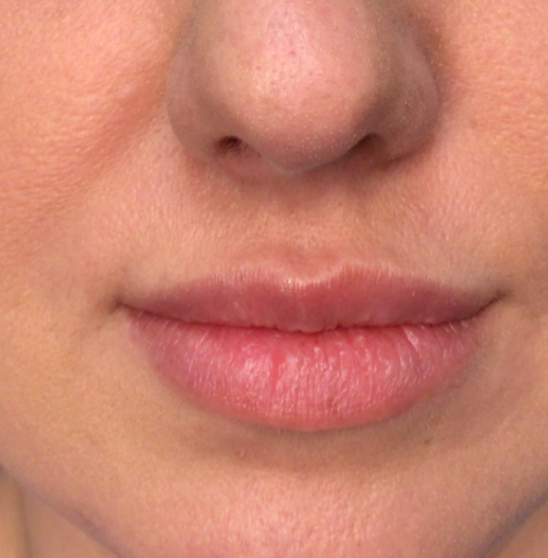 Lip Injections Case 43 After Image