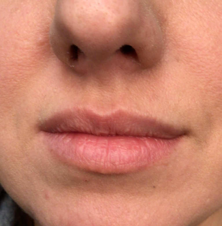 Lip Injections Case 43 Before Image