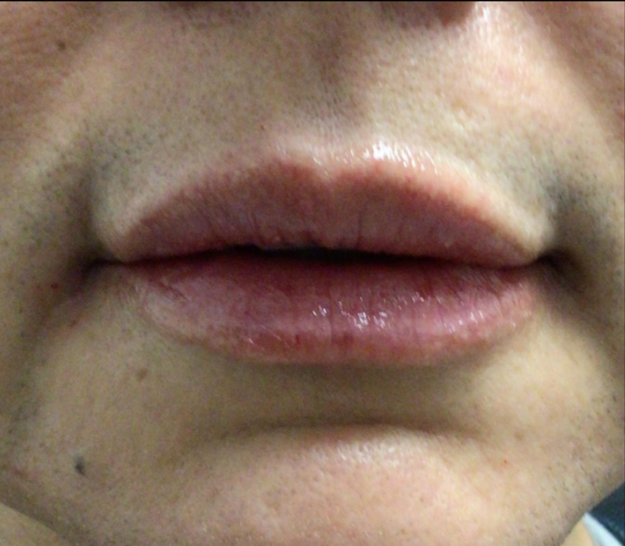 Lip Injections Case 44 After Image
