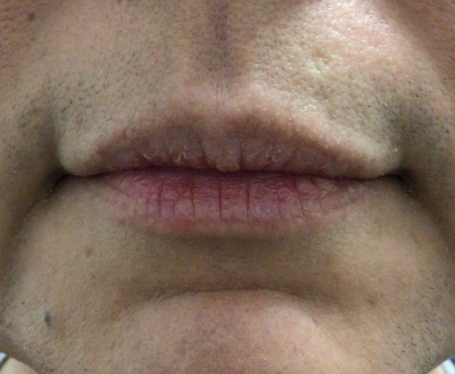 Lip Injections Case 44 Before Image