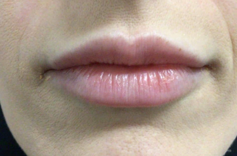 Lip Injections Case 45 After Image