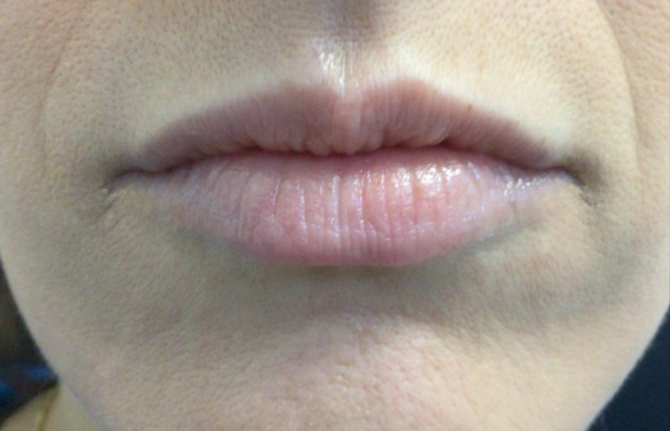 Lip Injections Case 45 Before Image