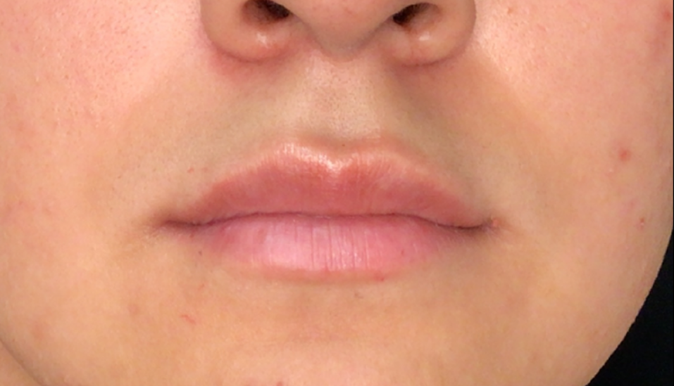 Lip Injections Case 46 After Image