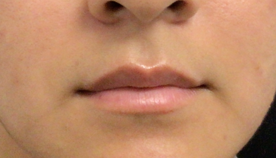 Lip Injections Case 46 Before Image