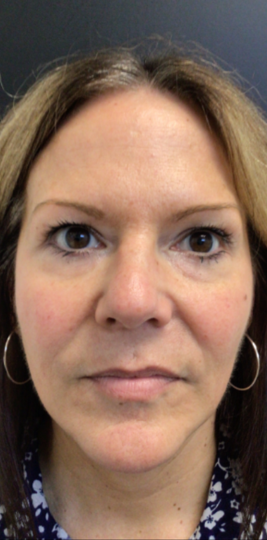 Dermal Fillers Case 69 After Image