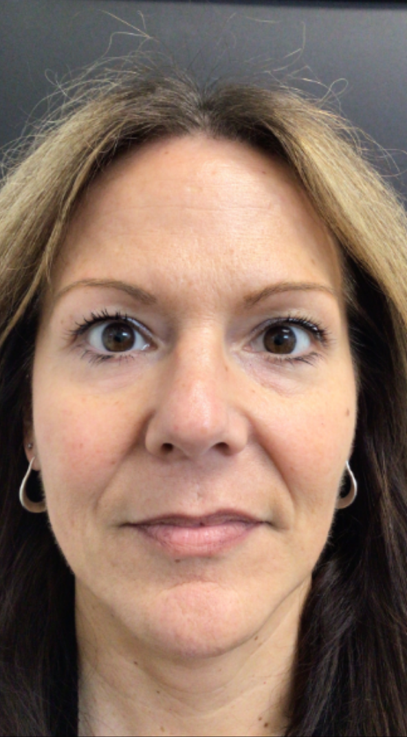 Dermal Fillers Case 69 Before Image