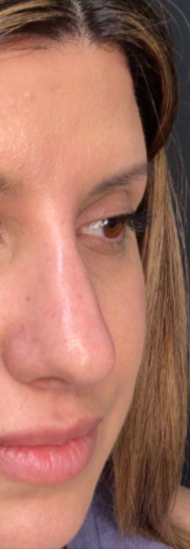 Dermal Fillers Case 70 After Image