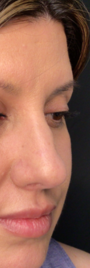 Dermal Fillers Case 70 Before Image