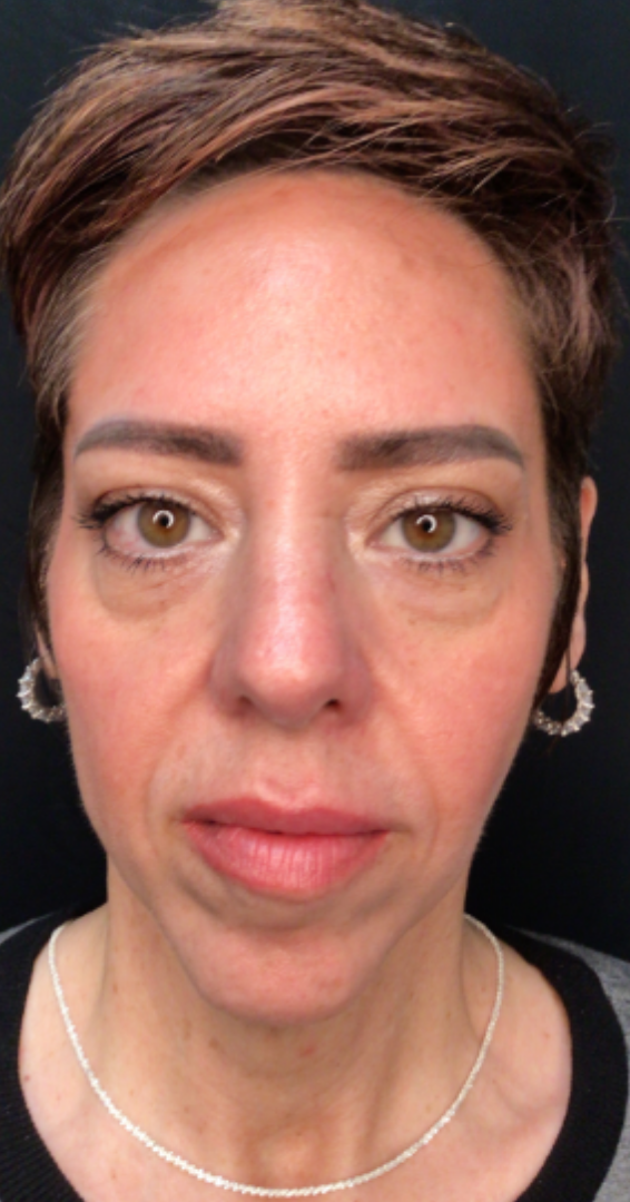 Dermal Fillers Case 71 After Image