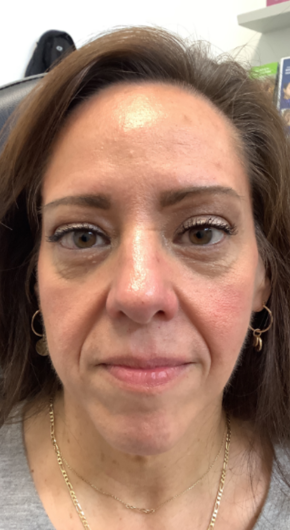 Dermal Fillers Case 71 Before Image