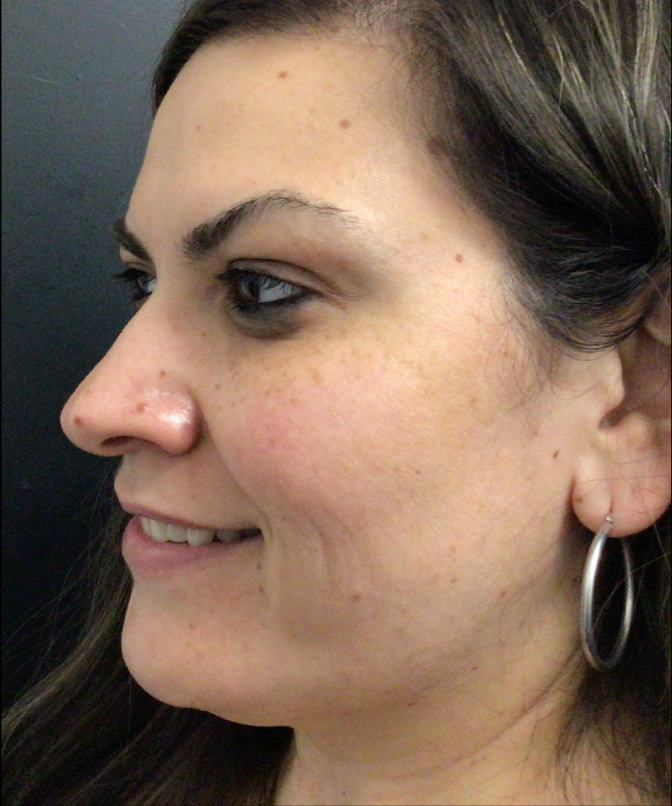Botox® / Dysport® Case 45 After Image