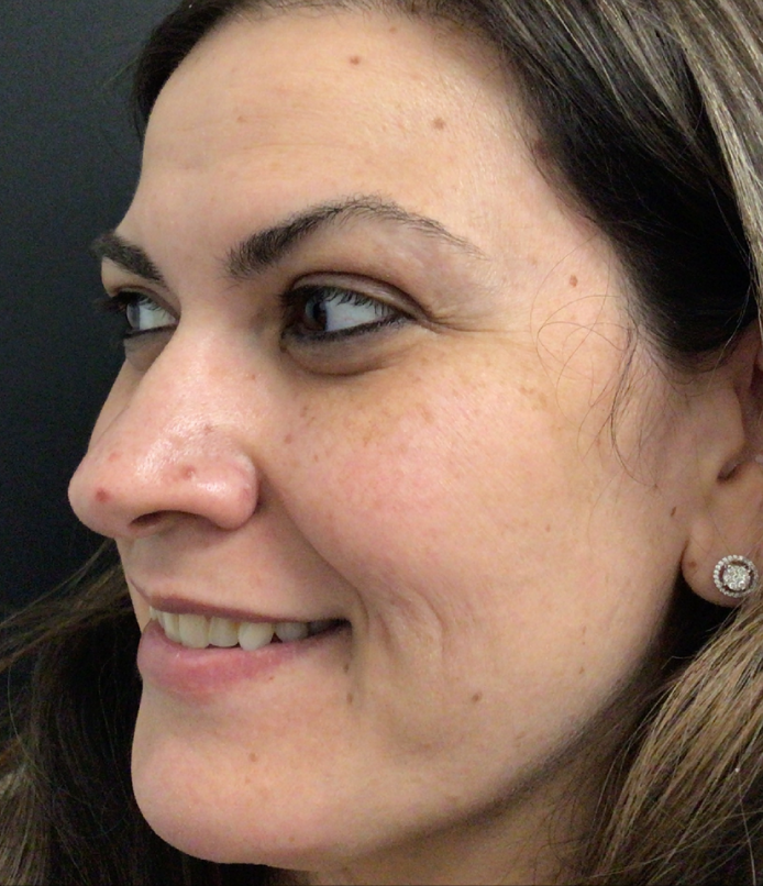 Botox® / Dysport® Case 45 Before Image