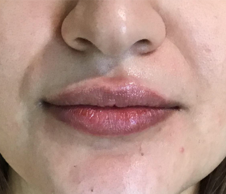Lip Injections Case 38 After Image