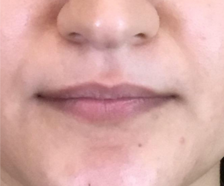 Lip Injections Case 38 Before Image