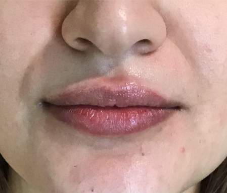 Dermal Fillers Case 48 After Image
