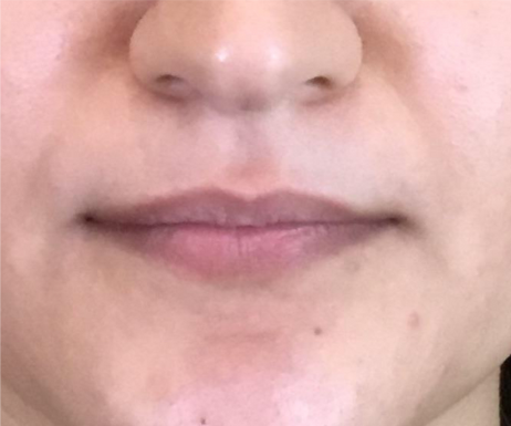 Dermal Fillers Case 48 Before Image