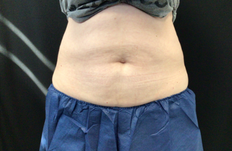 Coolsculpting® ELITE Case 45 After Image
