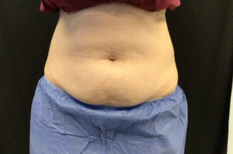 Coolsculpting® ELITE Case 45 Before Image