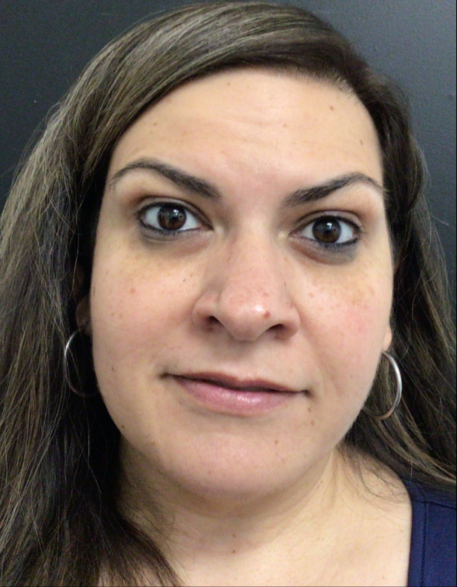 Botox® / Dysport® Case 45 After Image