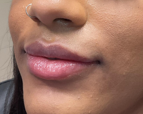 Dermal Fillers Case 66 After Image
