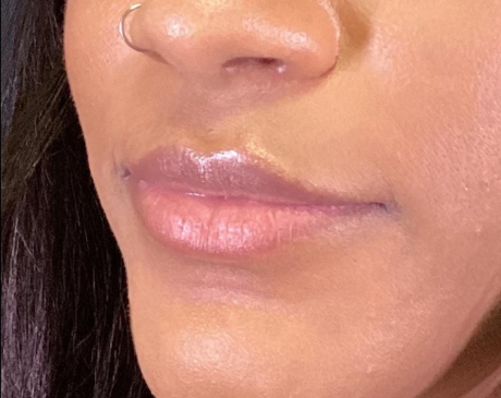 Dermal Fillers Case 66 Before Image