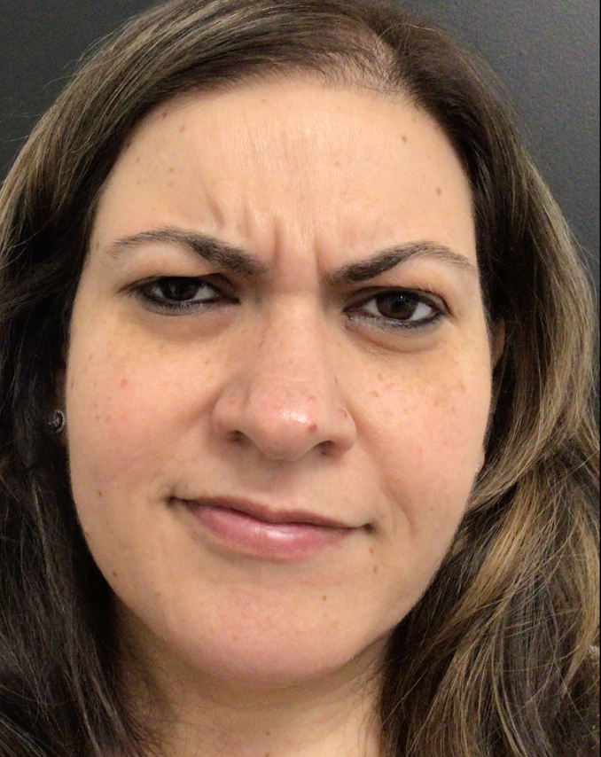 Botox® / Dysport® Case 45 Before Image