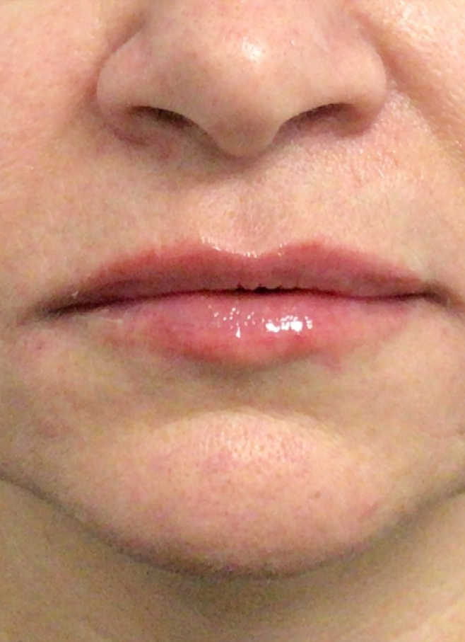 Lip Injections Case 47 After Image