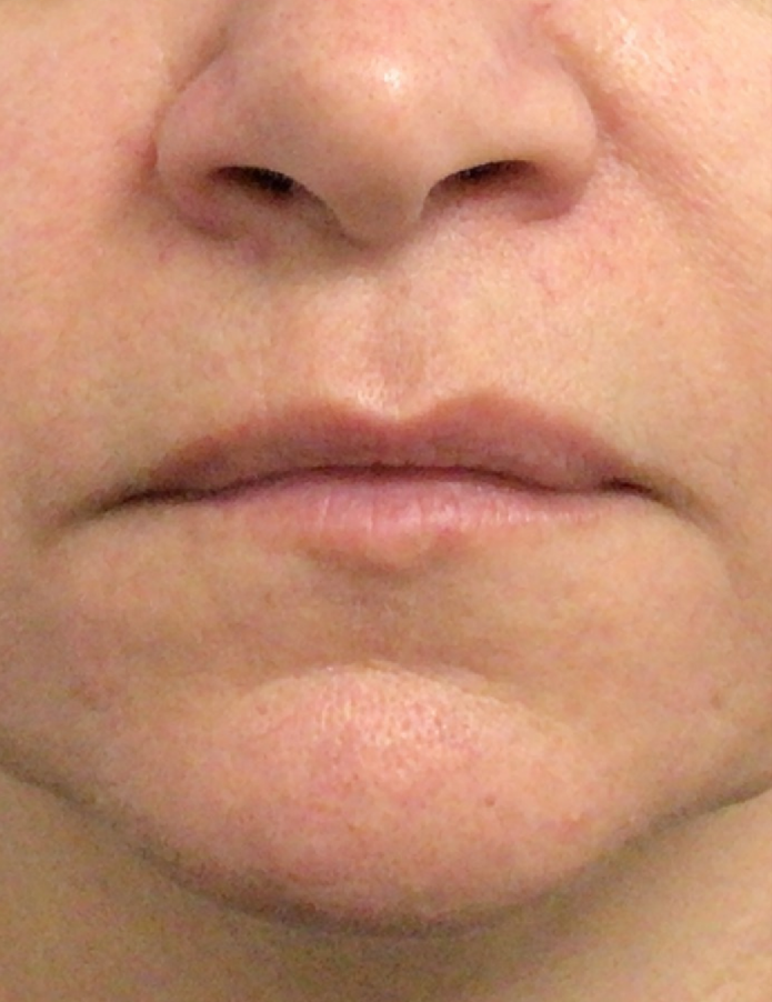 Lip Injections Case 47 Before Image