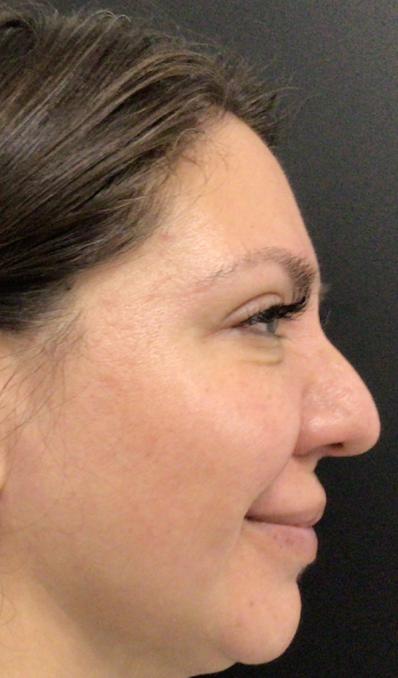 Botox® / Dysport® Case 46 After Image