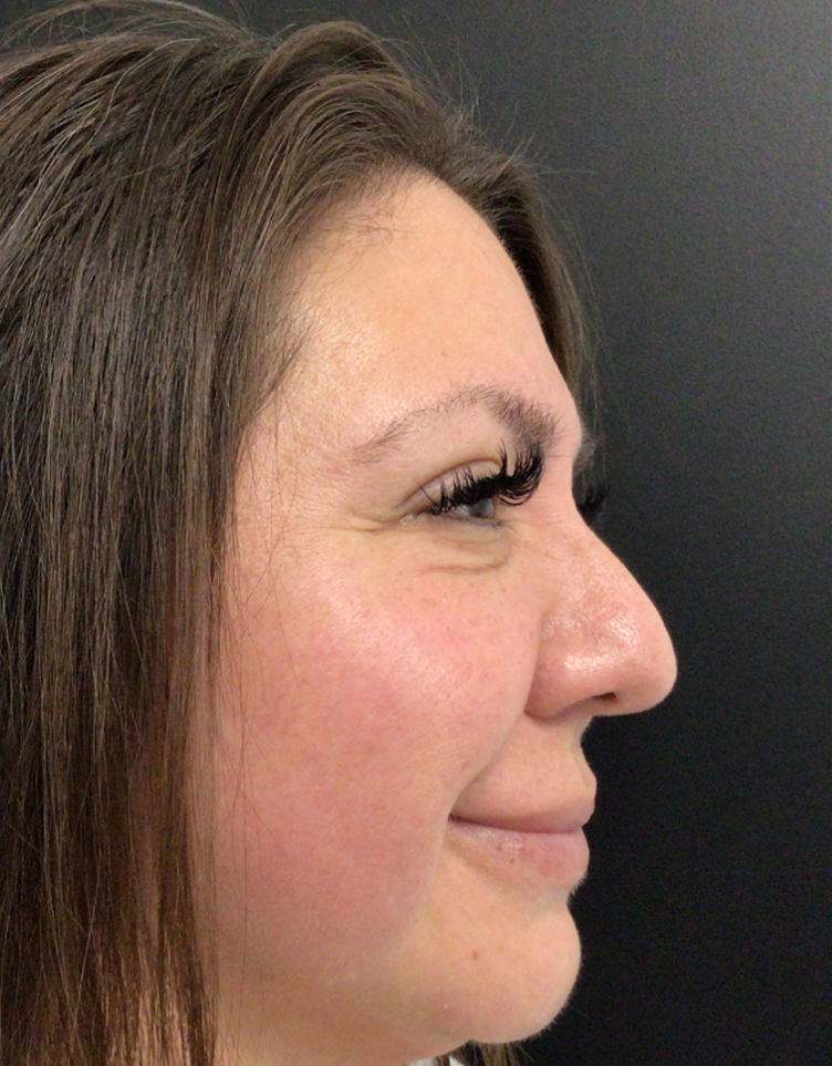 Botox® / Dysport® Case 46 Before Image