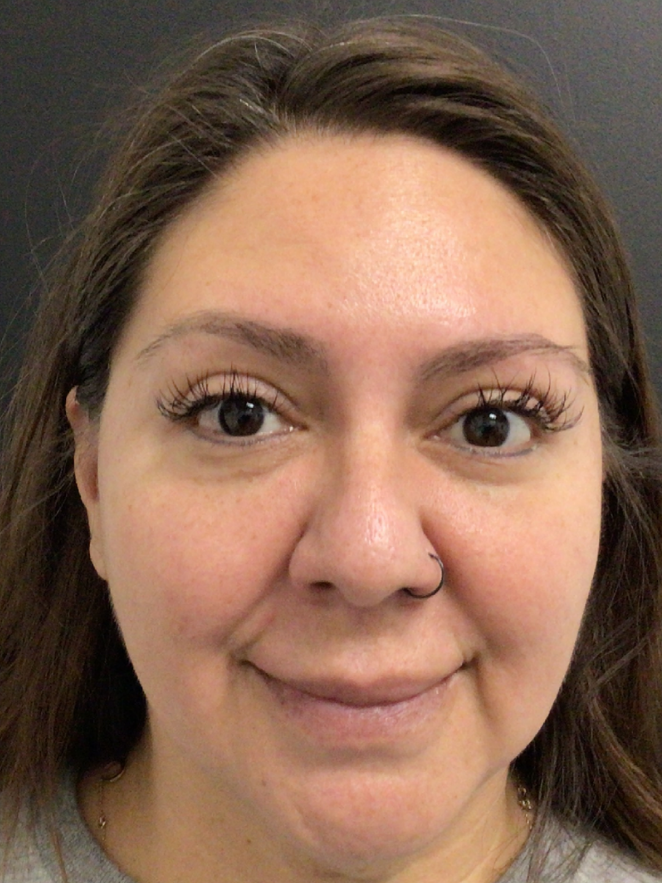 Botox® / Dysport® Case 46 After Image