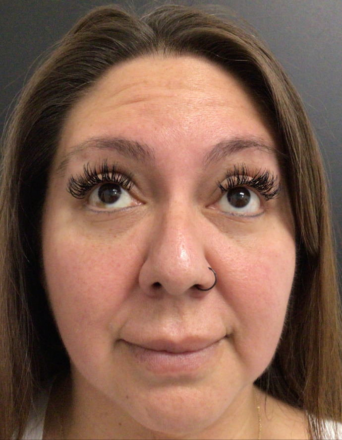 Botox® / Dysport® Case 46 Before Image