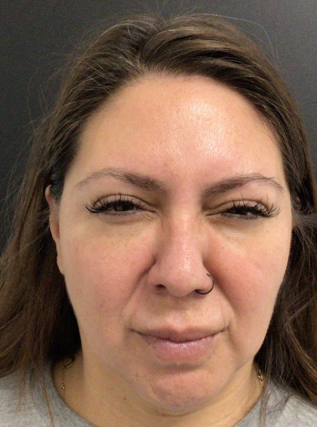 Botox® / Dysport® Case 46 After Image