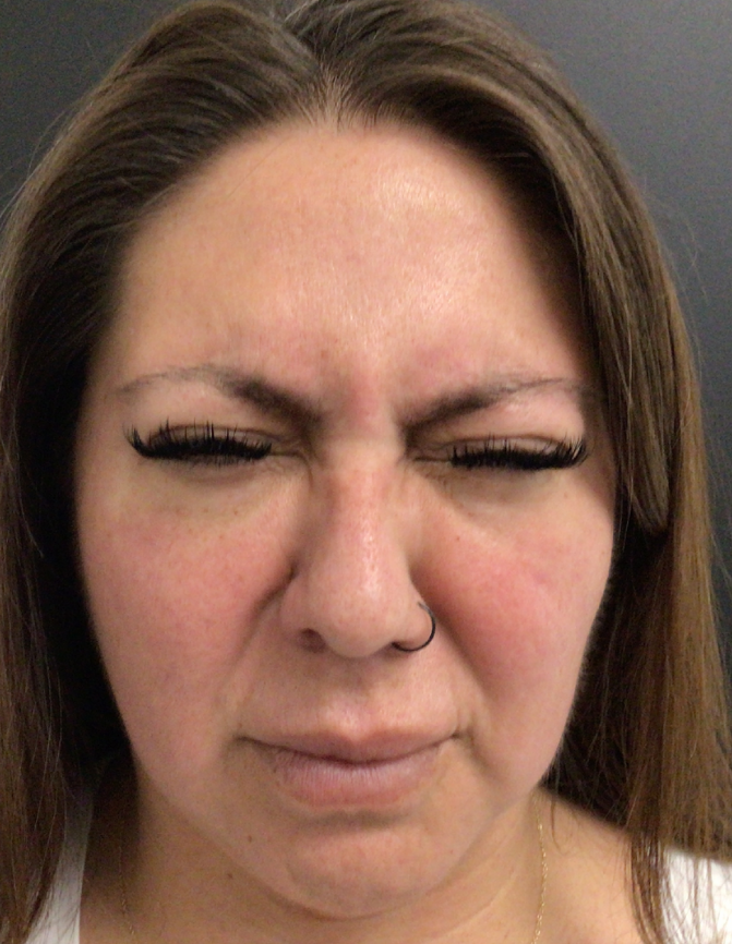 Botox® / Dysport® Case 46 Before Image