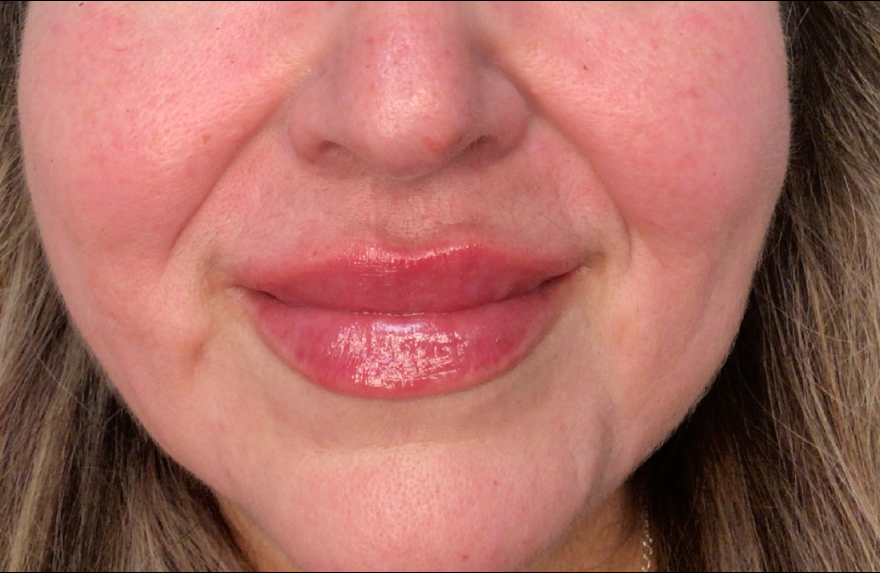 Lip Injections Case 48 After Image