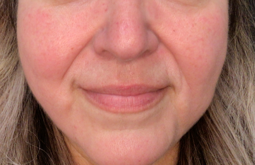 Lip Injections Case 48 Before Image