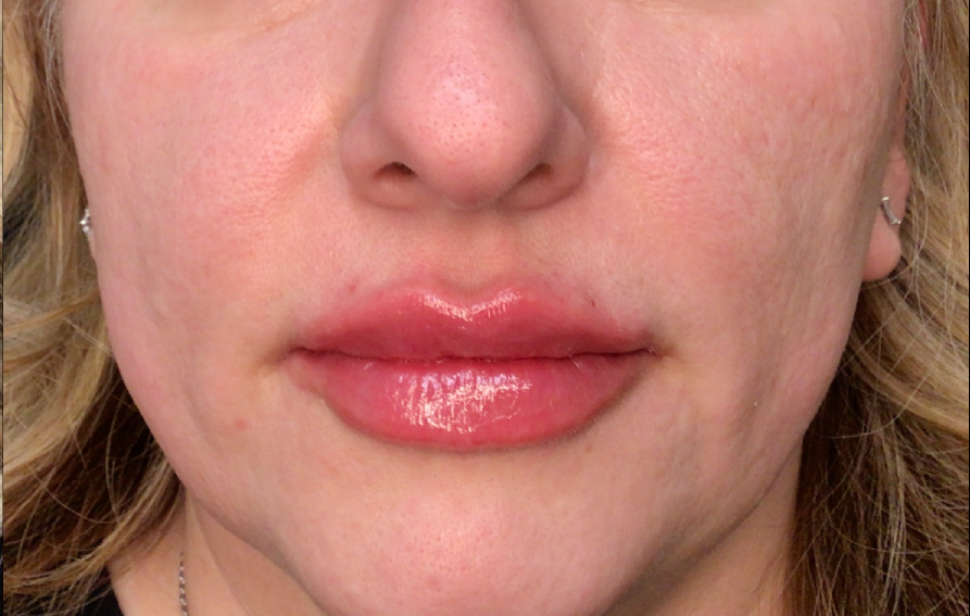 Lip Injections Case 49 After Image