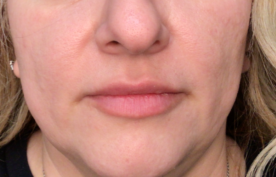 Lip Injections Case 49 Before Image