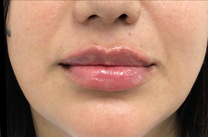 Lip Injections Case 50 After Image