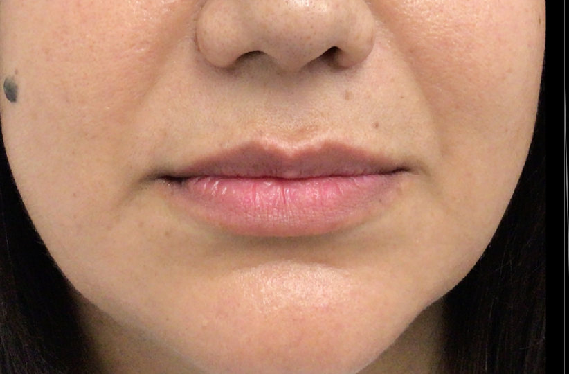 Lip Injections Case 50 Before Image