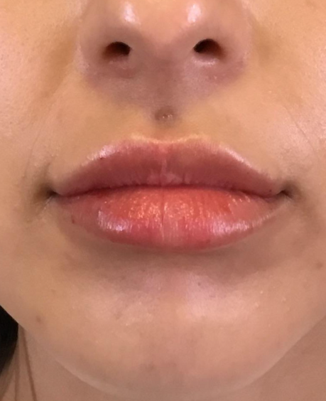 Lip Injections Case 35 After Image
