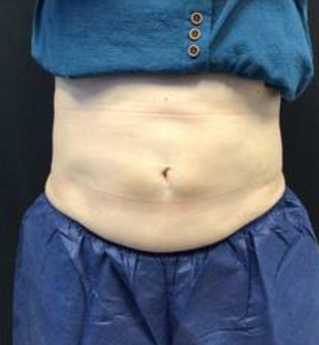 Coolsculpting® ELITE Case 54 After Image